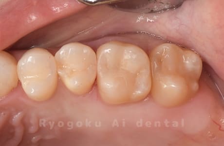 35ダイレクトボンディング、36セラミックインレー