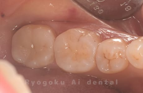 セラミックインレー修復