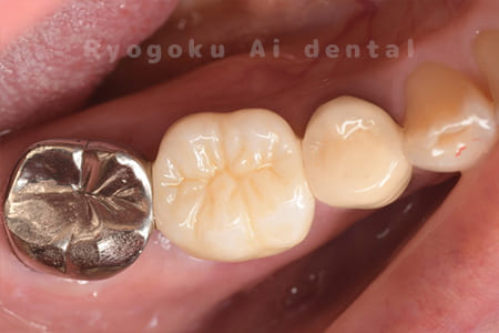 ジルコニアクラウン修復