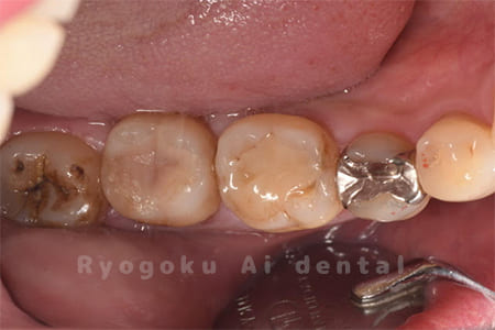 インレー2次カリエス