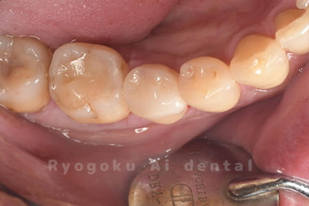 セラミックインレー修復