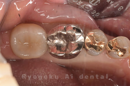 FMC二次カリエス