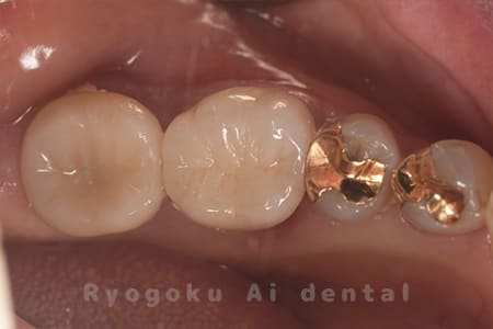 ジルコニアクラウン修復