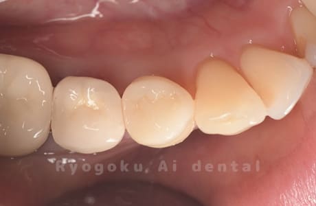 自家歯牙移植術後