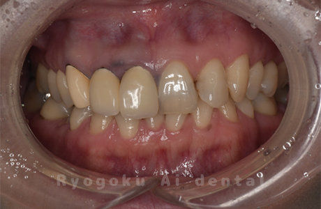 前歯部不良補綴物