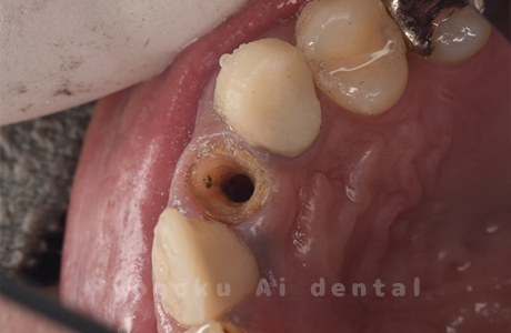 前歯部不良補綴物抜歯