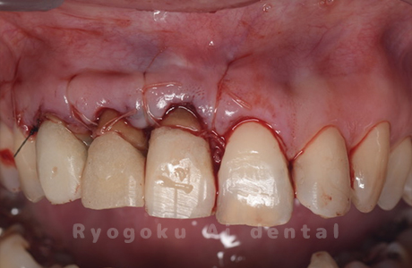 クラウンレングスニング