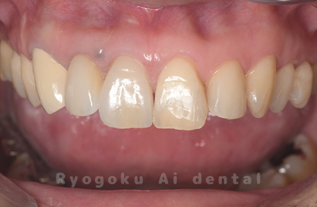 ジルコニアセラミッククラウン修復