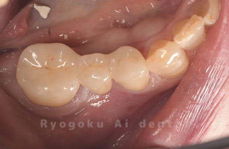 ジルコニアブリッジ修復