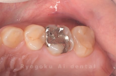 セラミックインレー破折、メタルインレー不適合