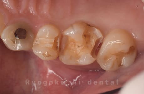 ダイレクトボンディング、セラミックインレー修復術中