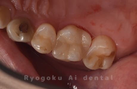ダイレクトボンディング、セラミックインレー修復術中