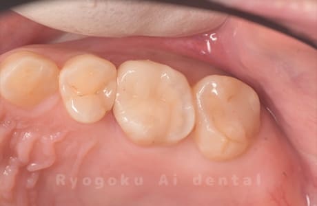 ダイレクトボンディング、セラミックインレー修復