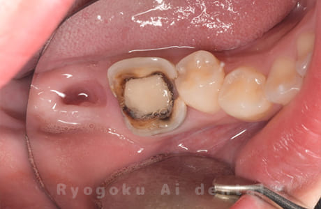 右下７番欠損、右下６番重度カリエス