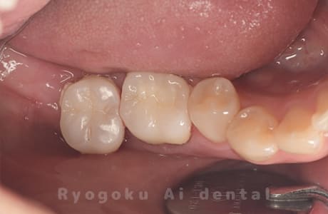 ジルコニアクラウン修復