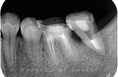 自家歯牙移植の術後