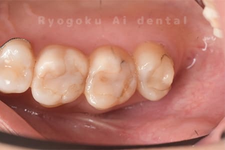 セラミックインレー破折