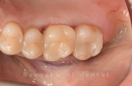 セラミックインレー修復、ダイレクトボンディング