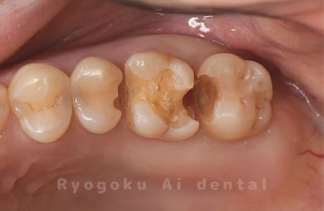 CR不適、重度カリエス