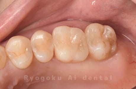 セラミックインレー修復、ダイレクトボンディング