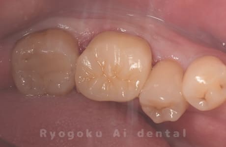 セラミッククラン修復、ダイレクトボンディング修復