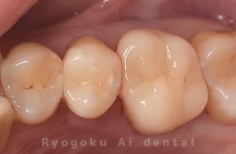セラミッククラン修復、ダイレクトボンディング修復