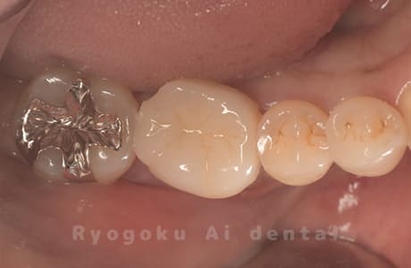 自家歯牙移植の術後