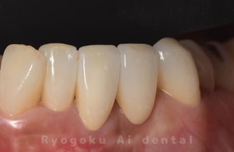 セラミッククラウン修復