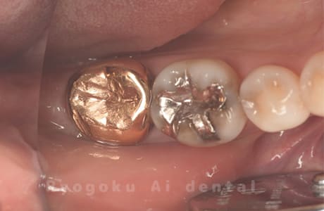 インレー不適、クラウン不適