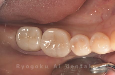 セラミック治療の術後