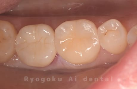 セラミックインレー修復、ジルコニアクラウン修復