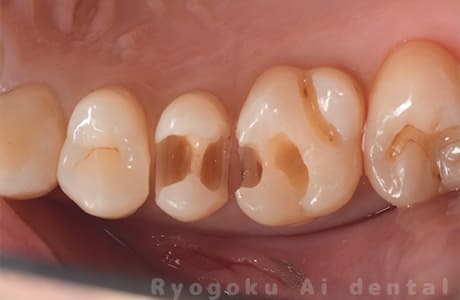 セラミッククラウン修復術前