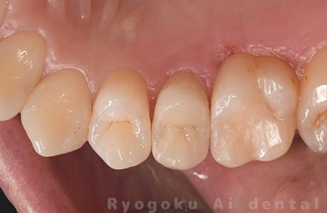 セラミッククラウン修復術後