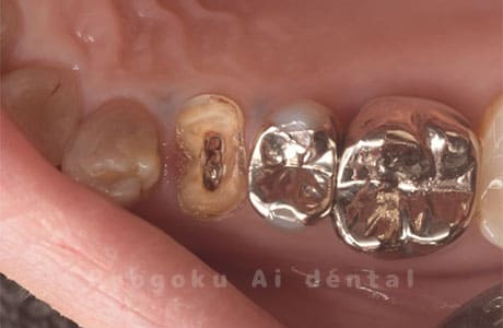 クラウン二次カリエス