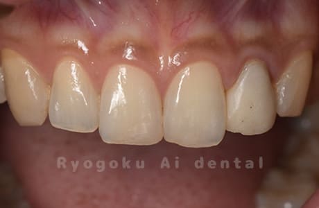 左上２番不良補綴