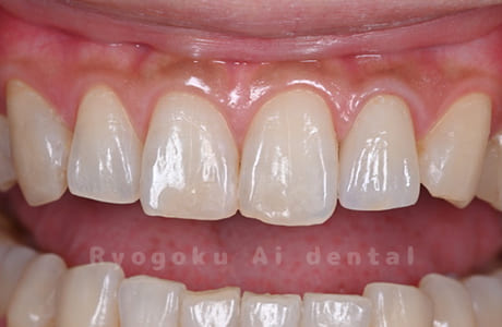 ジルコニアセラミッククラウン術後