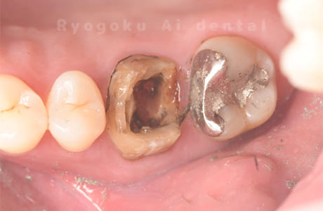 慢性根尖性歯周炎レントゲン