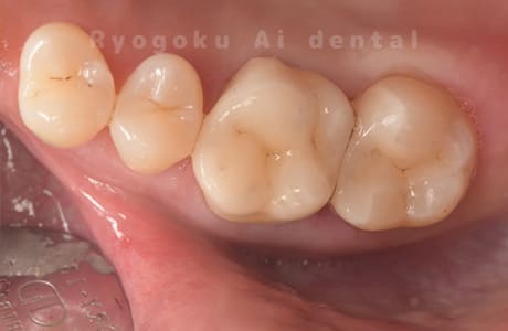 ジルコニア補綴レントゲン