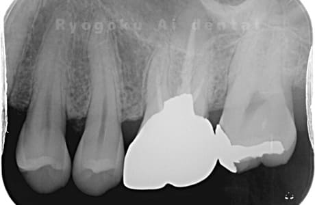 マイクロエンド治療、ジルコニア補綴