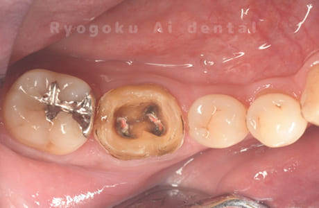 ジルコニア補綴治療、セラミックインレー修復術中