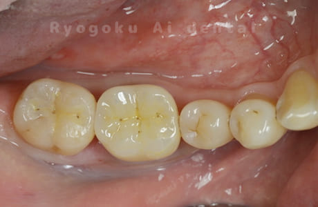 ジルコニア補綴治療、セラミックインレー修復術後
