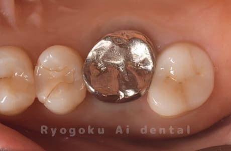 セラミッククラウン修復