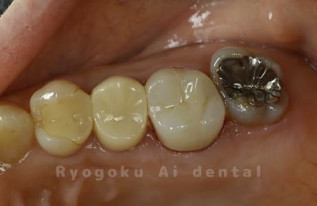 ジルコニアクラウン修復