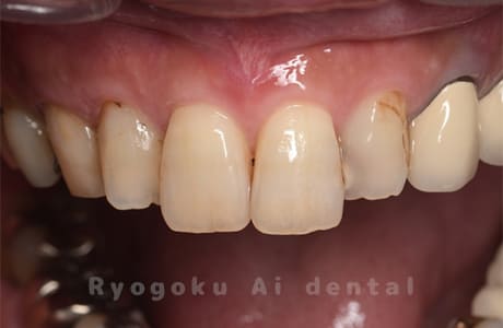 左上３番不良補綴、左上２番カリエス