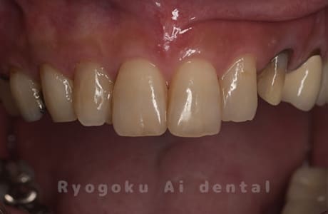 ダイレクトボンディング治療、ジルコニアセラミッククラウン治療術中