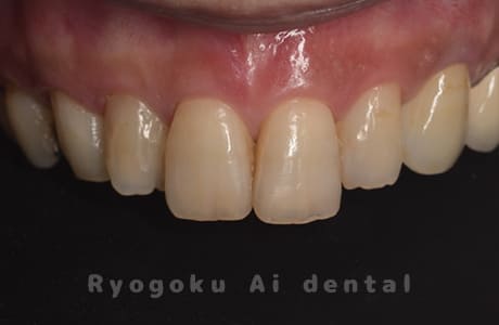 ダイレクトボンディング治療、ジルコニアセラミッククラウン治療術後