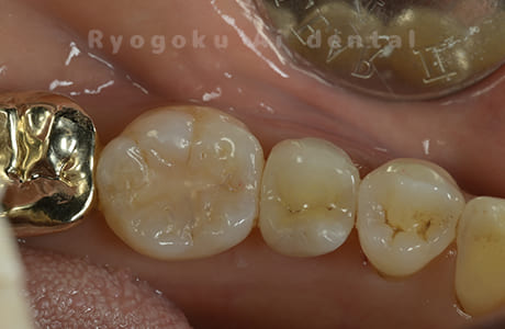 セラミックインレー修復