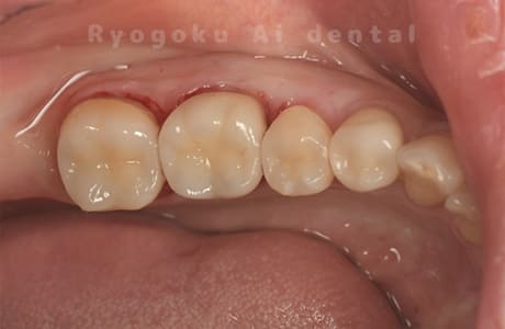 セラミックインレー並びにセラミッククラウン治療