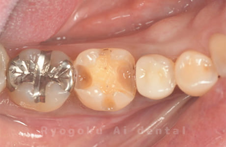 セラミックインレー修復術中
