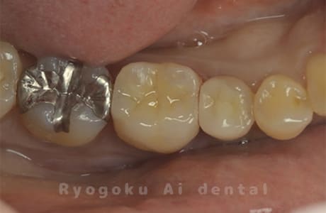 セラミックインレー修復術後